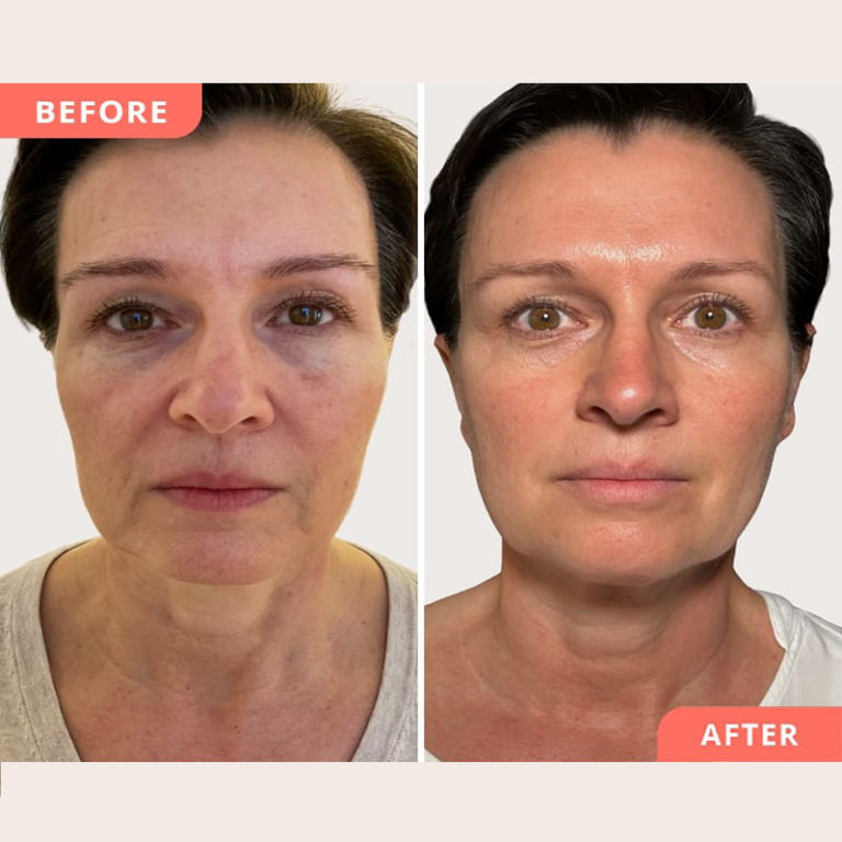 ba-full-face-rejuvenation-2